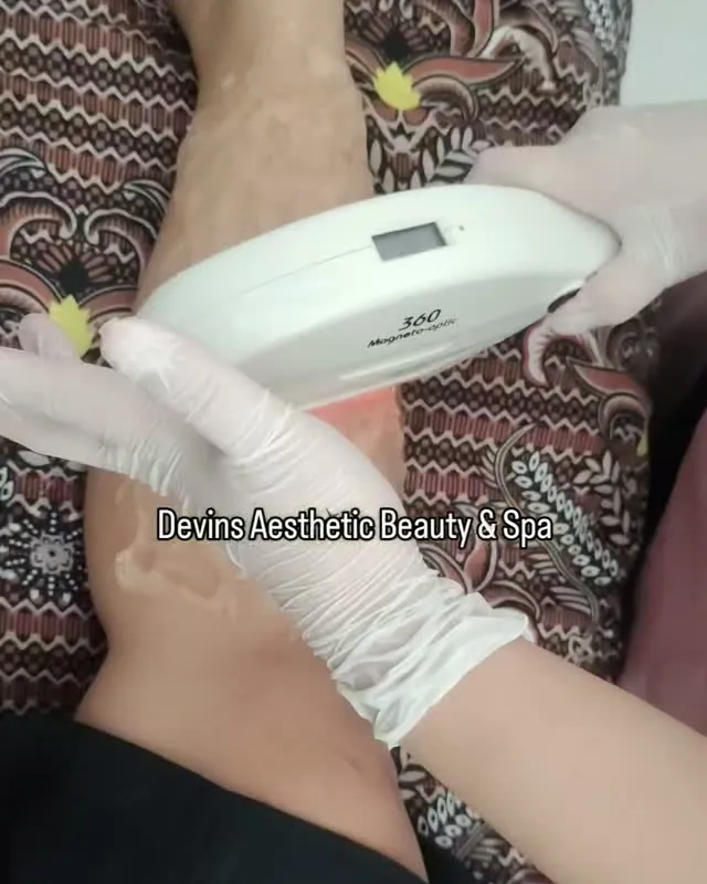 Perawatan IPL hair removal pada kaki
